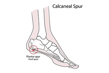 Posterior hot sale heel spur