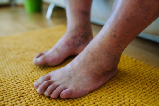 Diabetic Foot Conditions